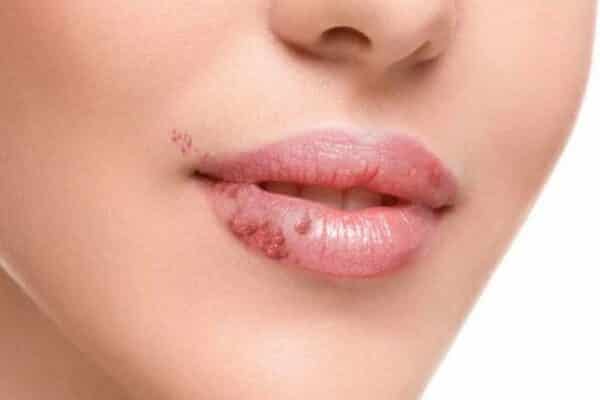 Comment se débarrasser des grains de Fordyce sur les lèvres : 6  astuces pour en venir à bout