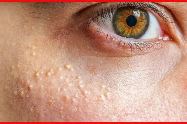 Qu’est-ce que le grain de fordyce et quels sont les traitements naturels ?