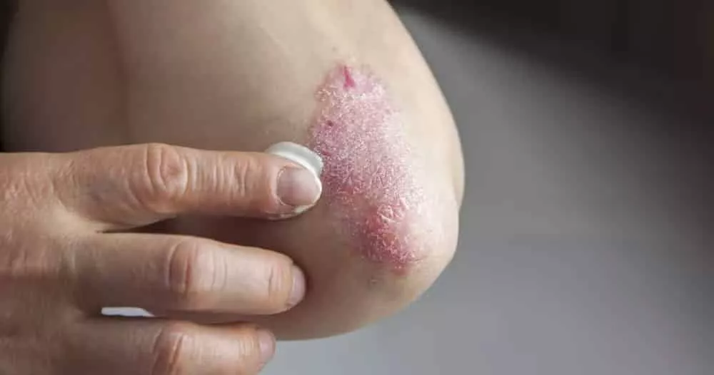 Psoriasis ou rougeur sur le verge ou sur tout le corps