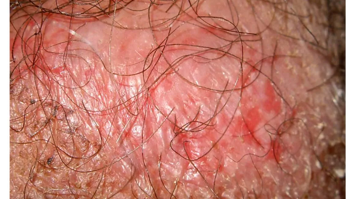 J’ai une rougeur sur la verge, photos et diagnostic des dermatologues