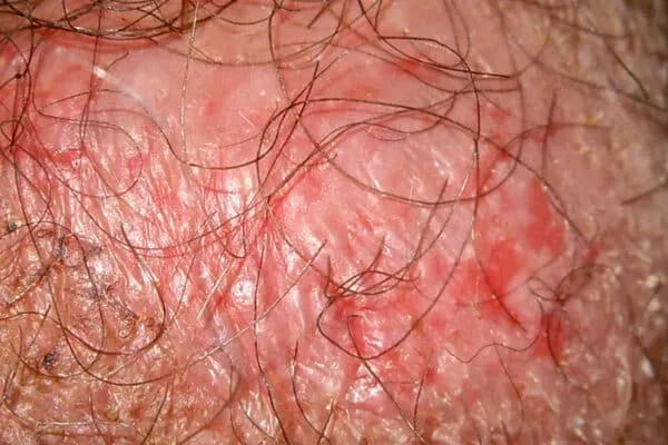 J’ai une rougeur sur la verge, photos et diagnostic des dermatologues